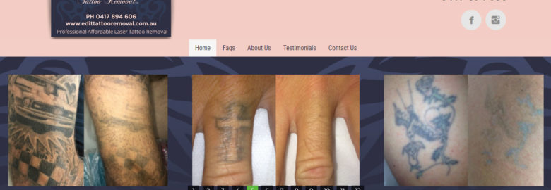 Edit Tattoo Removal